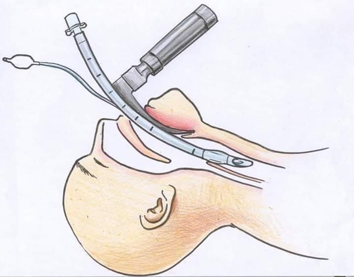 Pernafasan Buatan Covid-19
