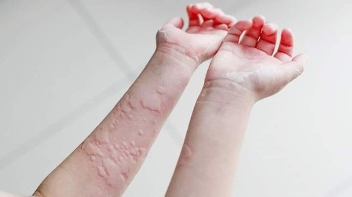 Obat alami untuk meredakan Penyakit Biduran